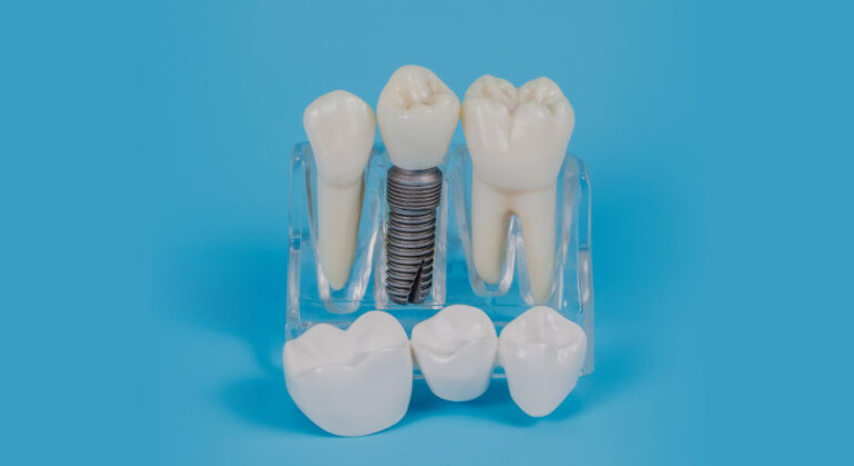 cabinet saint guillaume les protheses les differents types de protheses dentaires 02